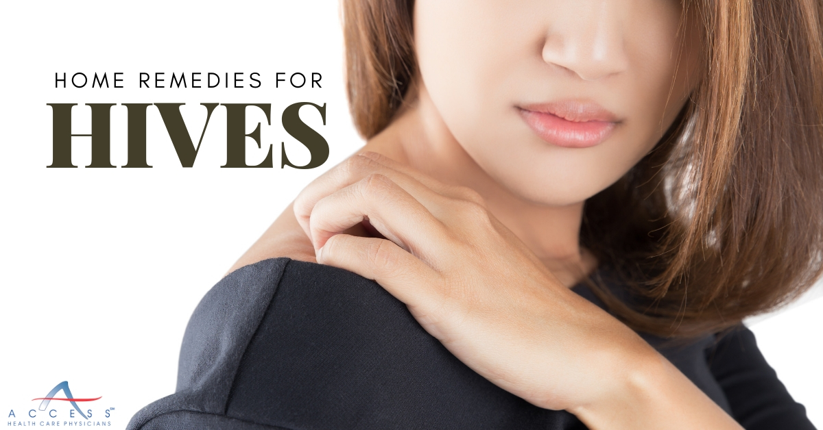 Home Remedies For Hives | Access Health Care Physicians